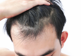 Psychological effects of hair loss