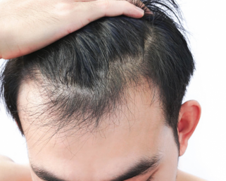 Psychological effects of hair loss